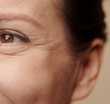 Diferencias entre arrugas estáticas y arrugas dinámicas